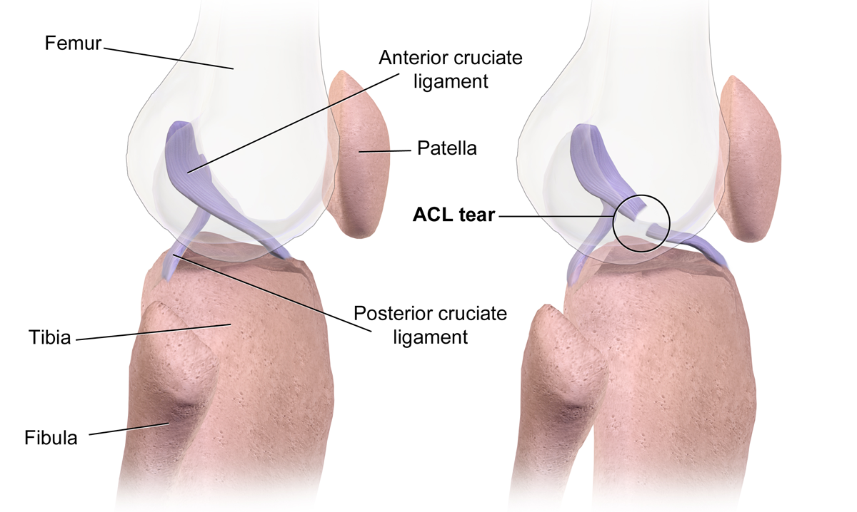 ACL_Tear ACL Tear