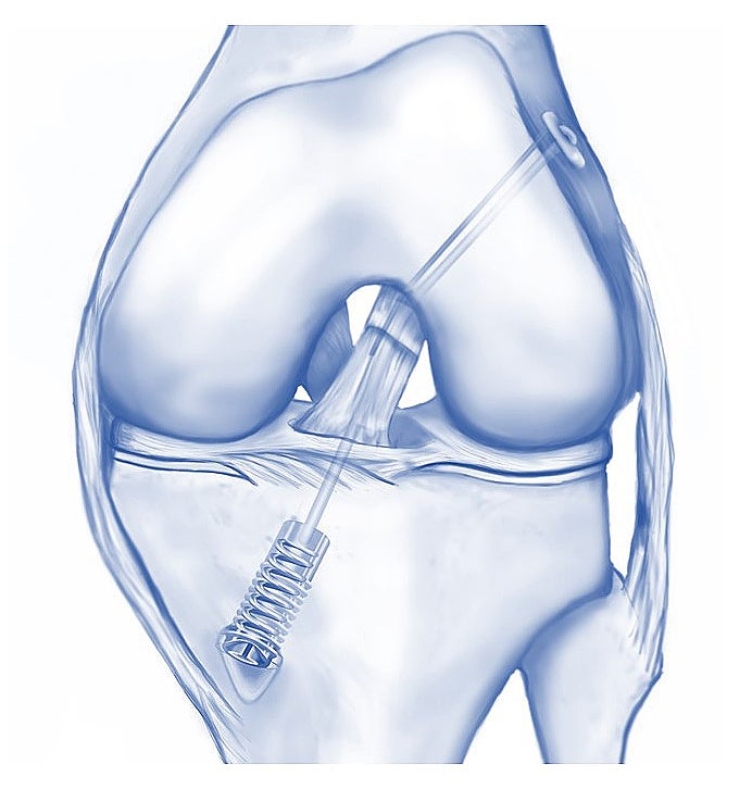 Kreuzbanderhalt_DIS_Ligamys Illustration of ACL reconstruction surgery technique