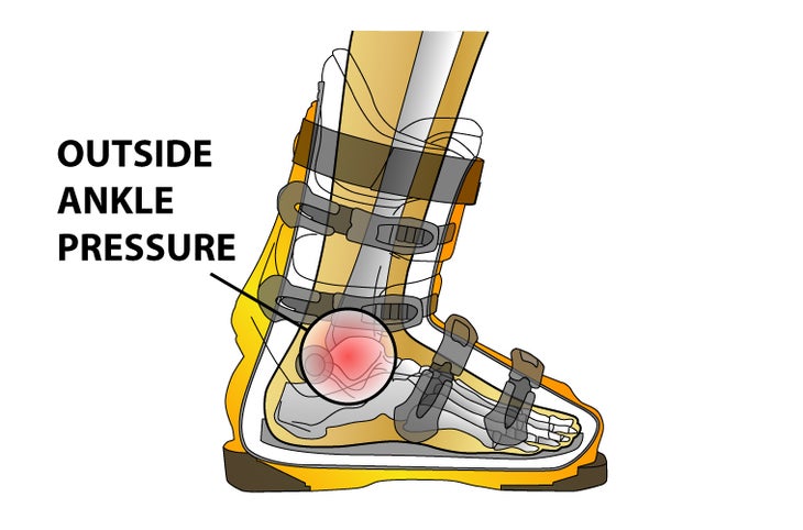 Outside Ankle Pressure Problem: Outside ankle pressure due to misalignment of the shell’s ankle pocket.Solution: Cut or pad the liner to relieve pressure. If necessary,…