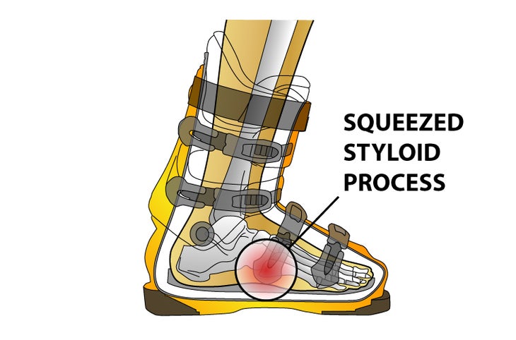 Styloid Process Problem: Narrow boots can squeeze the styloid process, that bony bump along the outside of the middle foot. Solution: Consider a wider boot, or grind…