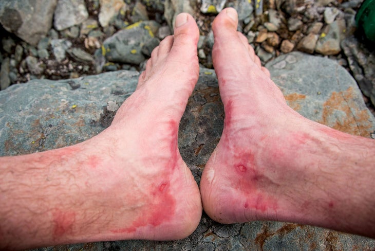SKG1216_BUGABOOS09 With every step, fresh agony.