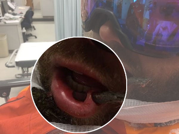 impale-close Hagood in his hospital bed close up on the puncture