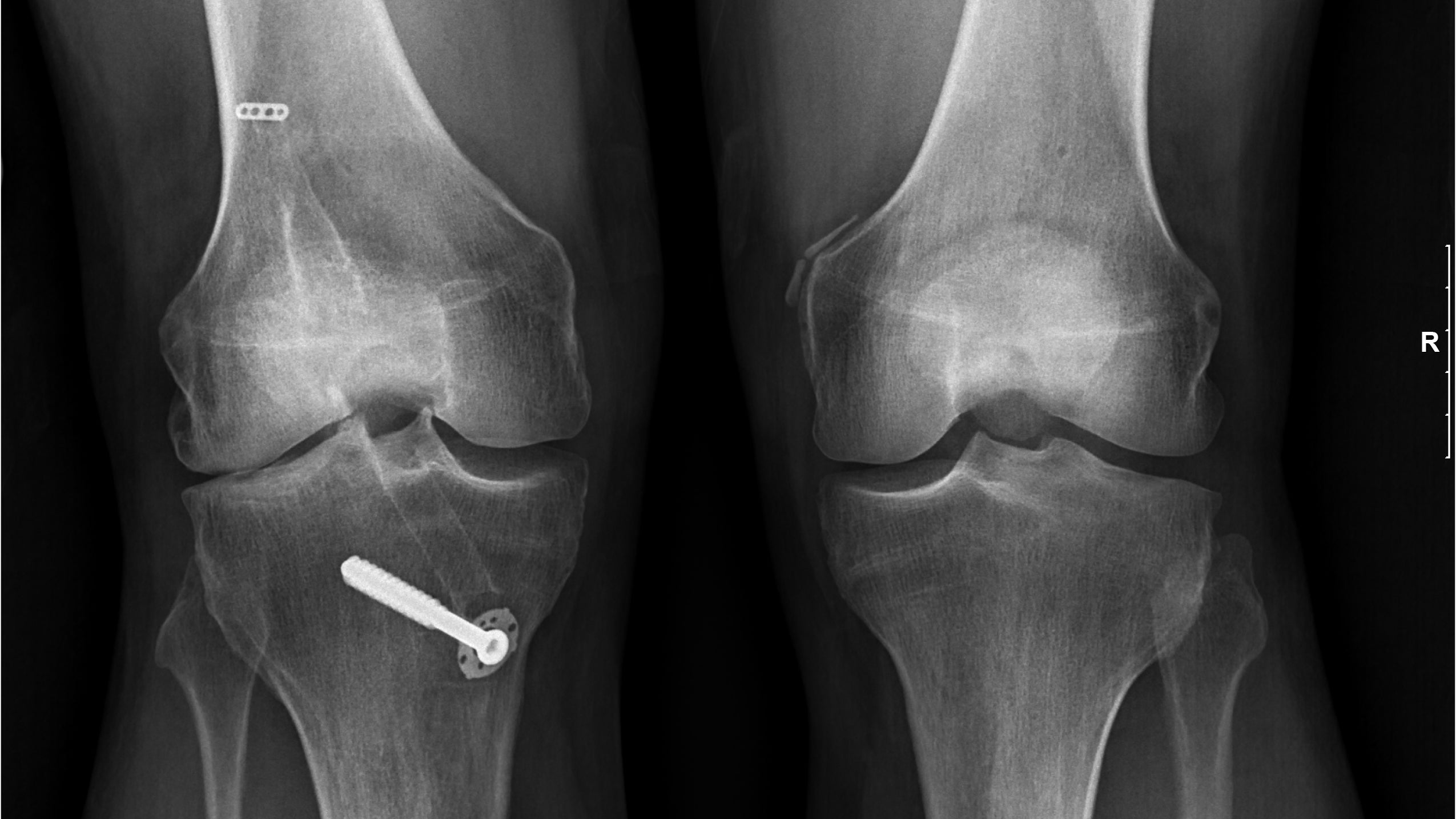 Stem Cell therapy for skiers knees